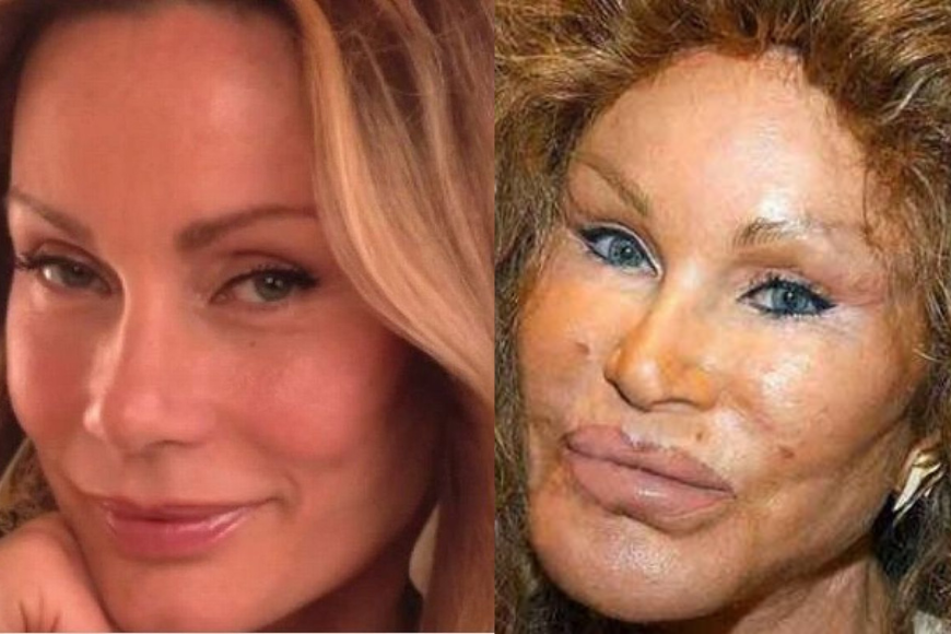 10 Celebs Who Ruined Their Faces Through Plastic Surgery