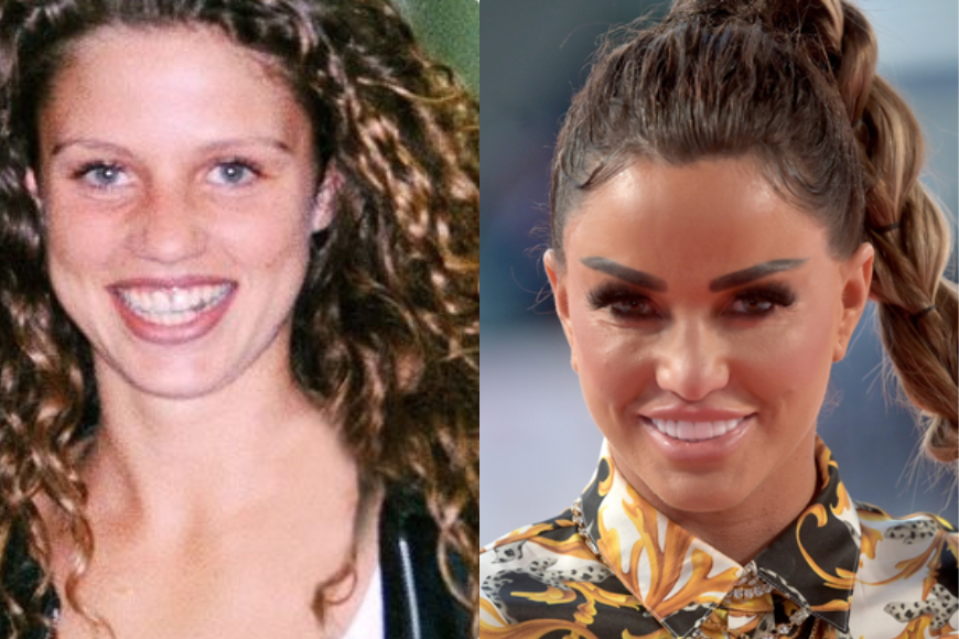 Katie Price before and after plastic surgery