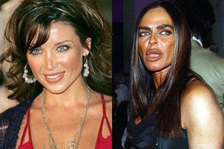 10 Celebs Who Ruined Their Faces Through Plastic Surgery