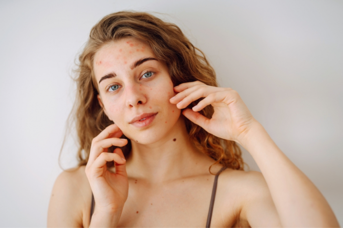 7 Ways Your Lifestyle Habits Are Giving You Acne