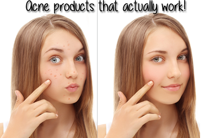 Acne Products That Actually Work