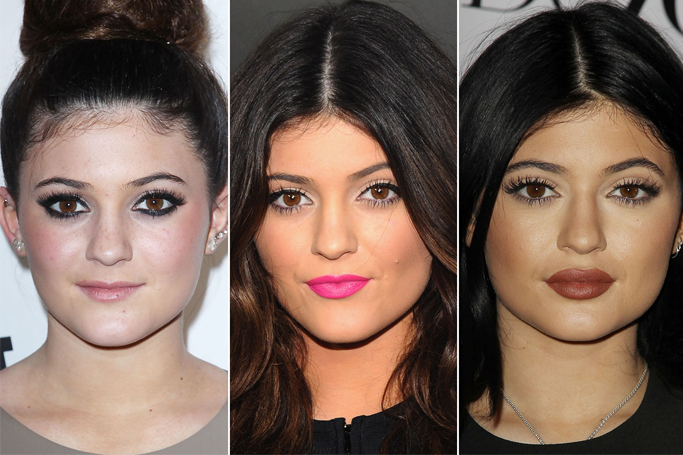 More And More People Are Getting Lip Injections, Thanks To Kylie Jenner