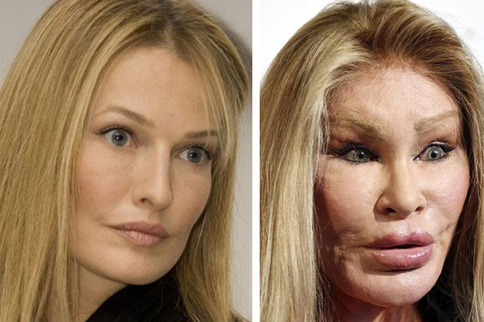 10 Celebs Who Ruined Their Faces Through Plastic Surgery Ewmoda