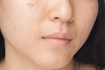 worst skin mistakes